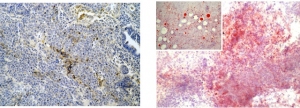 今回のがん幹細胞が形成した悪性脂肪肉腫の顕微鏡写真。がんを見やすくするために特殊な染色法によって色を付けている（岡山大学の発表資料より）
