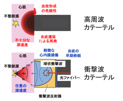 高周波カテーテルと衝撃波カテーテルの比較。（画像：東北大学発表資料より）