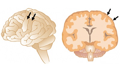 脳の表面に数多く存在する脳回（矢印）。（イラスト：金沢大学発表資料より）