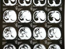 東京医科歯科大と富士通が新型コロナ肺炎患者の重症化や看護師の業務量を予測するAIの共同研究を開始 東京医科歯科大と富士通が新型コロナ肺炎患者の重症化や看護師の業務量を予測するAIの共同研究を開始