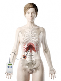 新たな呼吸管理方法「横隔膜ペースメーカー」をオンライン勉強会で紹介