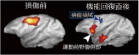 脳損傷前（左）と機能回復直後（右）のPET画像。回復直後には損傷前と比べて運動前野腹側部の活動が高まった（産総研の発表資料より）