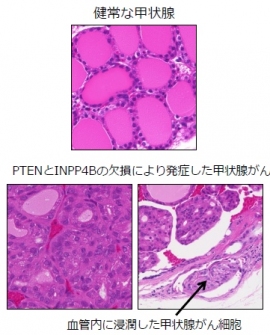 健康な甲状腺とPTENとINPP4Bの欠損によって発症した甲状腺がん(秋田大学の発表資料より) 健康な甲状腺とPTENとINPP4Bの欠損によって発症した甲状腺がん(秋田大学の発表資料より)