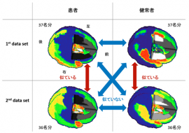 患者群と健常者群の脳部位モジュール解析(色の塗り分け)。 色の境界(塗り分け方)の類似性に基づいて判断する。(情報通信研究機構の発表資料より) 患者群と健常者群の脳部位モジュール解析(色の塗り分け)。 色の境界(塗り分け方)の類似性に基づいて判断する。(情報通信研究機構の発表資料より)