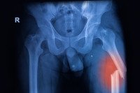 大腿骨骨折、X線による撮影図。