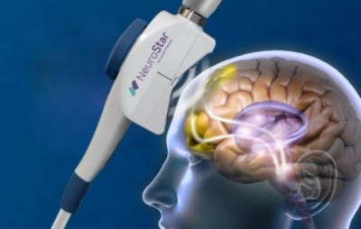 「NeuroStar」の使用イメージ(画像: 帝人ファーマの発表資料より)