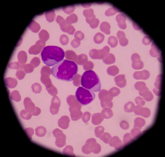 急性骨髄性白血病の病理像。