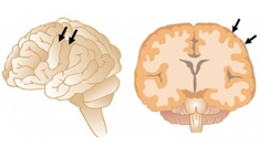 脳の表面に数多く存在する脳回（矢印）。（イラスト：金沢大学発表資料より）