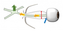 長期飛行を終えた帰還後の宇宙飛行士に、眼球後部平坦化（青矢印）や視神経鞘拡大（赤矢印）が、MRI画像で報告されている。その機序として、著者らは視交叉上方移動（緑色矢印）に続く、視神経の後退（黄色矢印）、拡大・変形（赤矢印）を論文の中で指摘した。（画像:京都大学発表資料より）