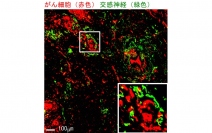 ヒトの乳がんに侵入する交感神経（写真：岡山大学の発表資料より）