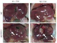 図１ KC マウスに発生した肝細胞癌。KC マウスでは 1年で小さな肝細胞癌が発生するが、 KC/TFF1KO マウスでは肝細胞癌は 6カ月で発生し、1年で巨大に発育した。（矢印：肝細胞癌） （画像: 名古屋大学の発表資料より）