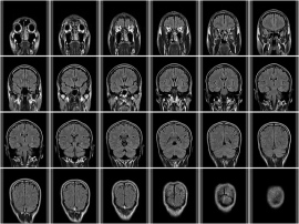 radikoがラジオ聴取と脳の成長の関係をMRI脳画像診断を用いて解明。ラジオを聴き続けることで記憶系脳が最大で2.4倍、聴覚系・理解系脳が最大で2倍成長 radikoがラジオ聴取と脳の成長の関係をMRI脳画像診断を用いて解明。ラジオを聴き続けることで記憶系脳が最大で2.4倍、聴覚系・理解系脳が最大で2倍成長