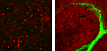 子宮頸部の正常組織（左）と子宮頸がん（右）。組織を切らずにがん診断が可能に。（写真：日本医療研究開発機構の発表資料より）