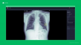 エルピクセルが開発した医用画像解析ソフトウェア「EIRL Chest Nodule」による画像。（画像: エルピクセルの発表資料より）
