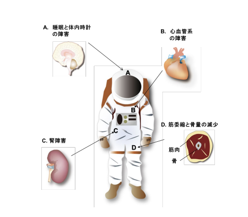 宇宙で引き起こされる疾患の例。メラトニンは、A、CおよびDの疾患を予防・治療できる可能性を秘めている。（画像:金沢大学の発表資料より）