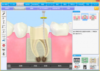 3Dアニメーションでわかりやすいインフォームドコンセントを実現　歯科医院向け患者治療用説明ソフト「デンタルカルチャー　Version.5」発売