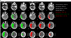 脳画像解析プログラム PMAneo　販売開始のお知らせ～ 医療機関向けに新たな医療用画像解析ソフトウェアを販売 ～