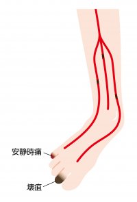 藤田医科大学病院に「足の血管センター」が開設