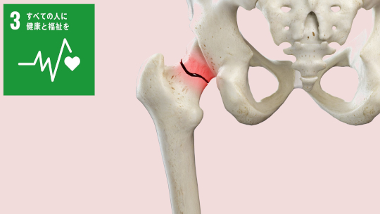 機械学習により高齢者の大腿骨骨折を家庭で予測する8因子を同定~骨折予防への発展に期待~