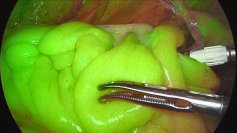 世界初ICGを用いた腸管血流の蛍光観察が直腸がんの術後合併症を低下させることを確認