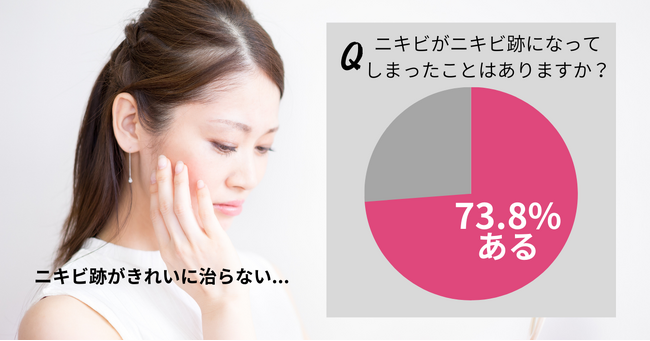73.8％の女性が「ニキビ跡になってしまった」経験アリ。ニキビ・ニキビ跡を悪化させない方法を紹介！