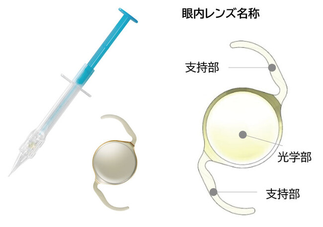 新非球面構造を採用した眼内レンズ　「ネックスロード　NSP-3」を発売