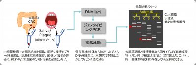 大腸がんに口腔内と同一菌株由来のフソバクテリウム・ヌクレアタムが侵入していることを確認