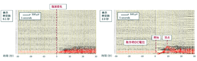 難治てんかん焦点の新しいバイオマーカー「発作時DC電位」 世界で初めて時定数2秒でも有用であることを明らかに