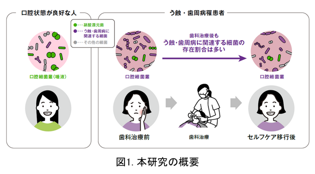 う蝕・歯周病罹患者の口腔細菌叢(※1)は歯科治療後も口腔状態が良好な人(※2)と異なることを解明