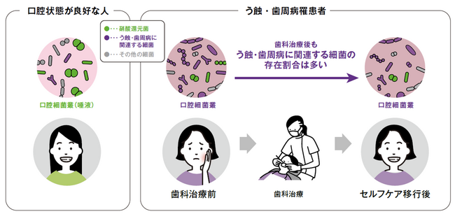 う蝕・歯周病罹患者の口腔細菌叢は歯科治療後も口腔状態が良好な人と異なることを解明