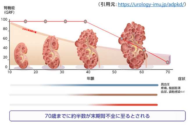 リジェネフロ、長船健二教授の研究グループが発見した常染色体顕性（優性）多発性嚢胞腎（ADPKD）の治療薬候補の臨床試験を近く開始
