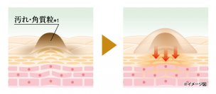 これからの季節、コートを脱いだら気になる・・！
「首のポツポツ(※1)」貼って隠して、なめらか肌へ