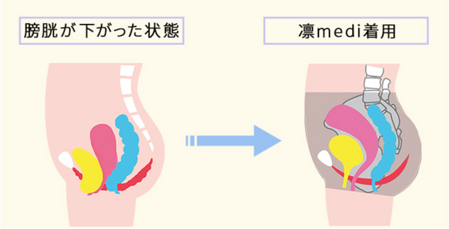 出産や加齢、咳のしすぎも原因となる膀胱瘤　累計販売34万枚超の骨盤インナーメーカーが膀胱瘤による尿もれを改善する一般医療機器のサポートショーツを発表