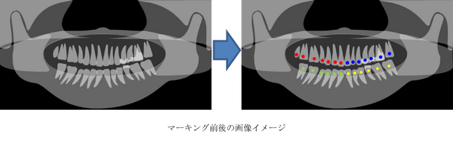 歯のレントゲン画像から個々の歯を識別する手法の特許を取得