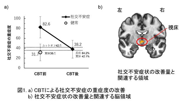 社交不安症の患者に対する認知行動療法の治療効果を安静時脳機能MRIで証明～社交不安症患者の治療効果を予測するバイオマーカー開発に期待～