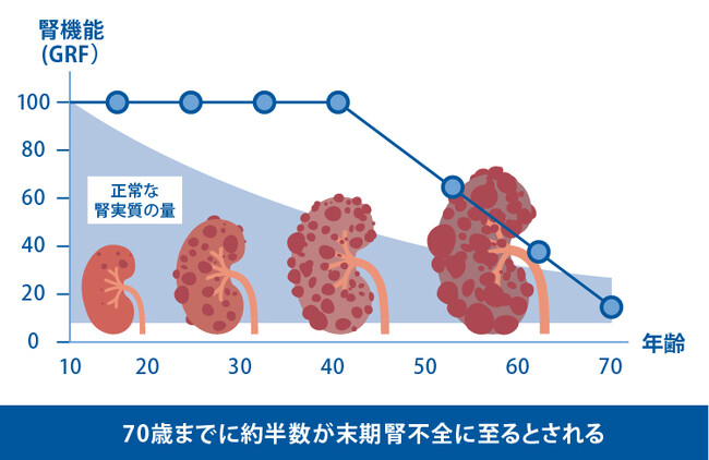 リジェネフロ、iPS創薬により発見した多発性嚢胞腎治療薬候補の前期第二相臨床試験を開始