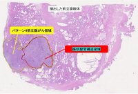【東京医科大学】前立腺がんの篩状腺管構造と再発との関連 ～前立腺がんの悪性度分類の改訂の際に重要な知見を報告～