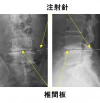 椎間板への多血小板血漿（PRP）注射の安全性と有効性を検証