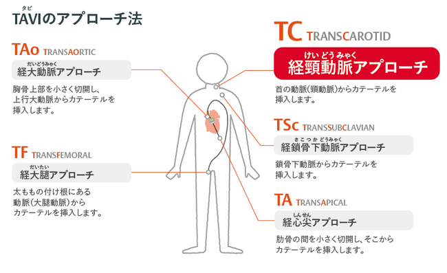 経カテーテル大動脈弁治療（TAVI）用のバルーン拡張型人工心臓弁 本邦における治療オプションがさらに拡大