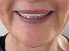 夜専用「おやすみ入れ歯」を着用した口元 夜専用「おやすみ入れ歯」を着用した口元