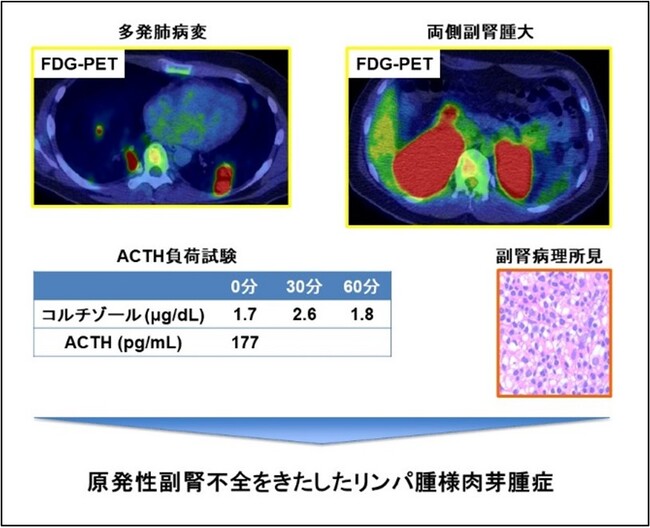 原発性副腎不全をきたしたリンパ腫様肉芽腫症を報告～日本で初めて、世界でも数件しか報告されていない希少な病態～