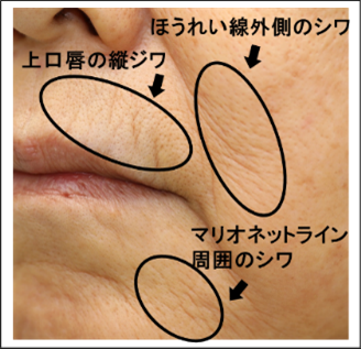 サンスター、口まわりのシワグレード標準を作成 第24回抗加齢医学会総会にて発表