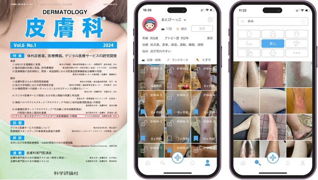 日本最大級のアトピー患者向けアプリ「アトピヨ」代表・赤穂が皮膚科専門誌「皮膚科」7月号に執筆！ ～デジタル技術で変わるアトピー患者支援の未来～