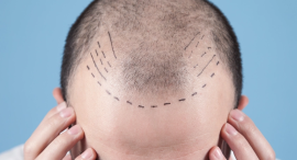 サファイアFUE法 サファイアFUE法