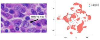 腫瘍微小環境内の骨髄前駆細胞が乳癌患者の予後と相関することを発見