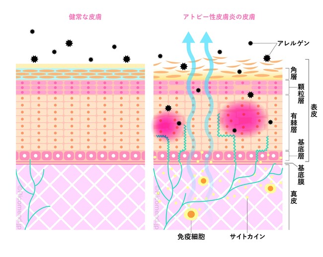 アトピー性皮膚炎治療に新たな知見！　世界最小＊1「ナノサイズ微細水粒子AIR（アイル）」がアトピー性皮膚炎の症状を緩和する可能性