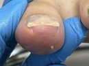 補正後の爪(器具が付いた状態) 補正後の爪(器具が付いた状態)