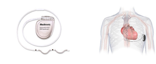 日本メドトロニック　血管外に留置する植込み型除細動器「Aurora EV ICD(TM) MRI デバイス」「Epsila(TM) EV MRIリード」の薬事承認を取得