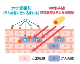 株式会社CICS（リゾートトラスト株式会社の連結子会社）、血管肉腫を対象としたBNCT（ホウ素中性子捕捉療法）の国内第II相臨床試験の主要評価に関する90日間の観察期間が完了