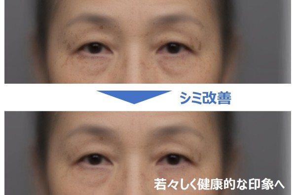シミ部位と対人印象の関係を解明 目まわりのシミ改善により若々しく健康的な印象へ